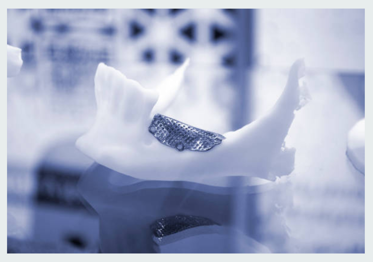 Customised Medical Implants